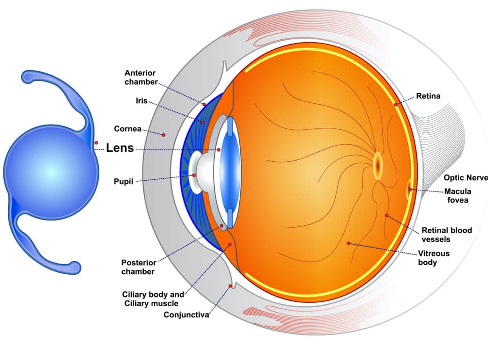 Intraocular lenses: (IOLs) are medical devices that are implanted inside the eye to replace the eye's natural lens when it is removed during cataract surgery.