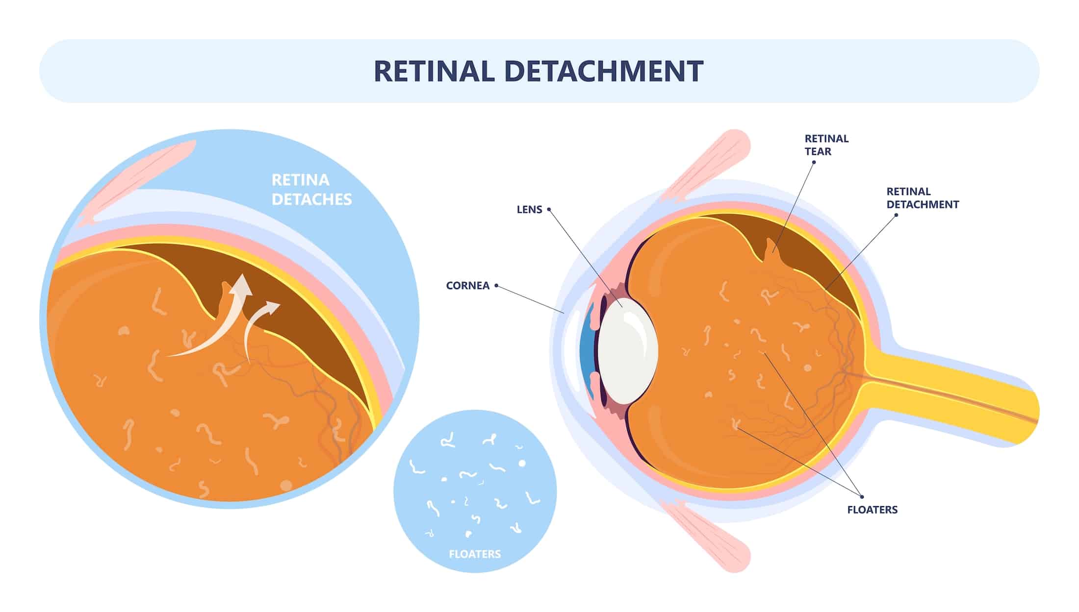 Eye floaters fluid vision retina myopia trauma surgery loss of light tear torn laser surgical repair older Detached blurry shadow Pain injury hole macular Age treat blood dark lose wear Pars Plana