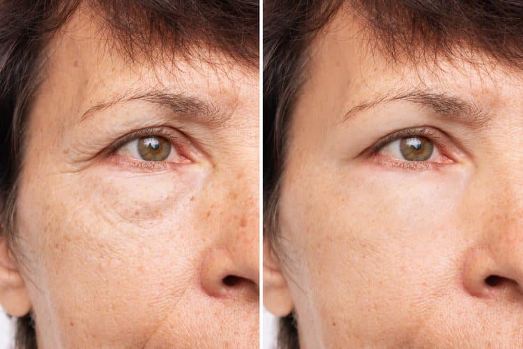 Image of a woman's eye before and after upper and lower blepharoplasty
