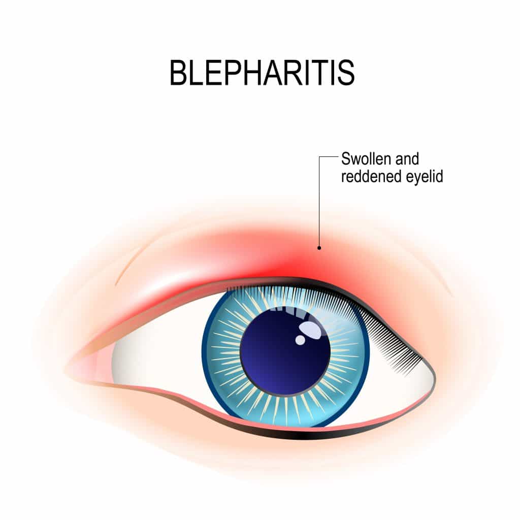 illustration of a red irritated eye